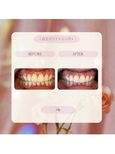 プラスビー 2号店(+b)/ホワイトニングビフォーアフター
