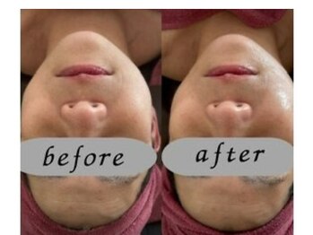 アイリーボーテ 東大阪(アイリーBEAUTE)/ダイヤモンドピーリング