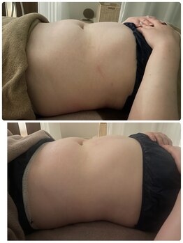 サルサナ(Salu Sana)/脂肪分解セラム導入　