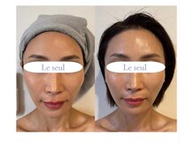 幹細胞導入で中顔面短縮も◎ハリ艶/小顔も叶う☆ 銀座幹細胞