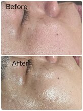 ルミネル 名古屋新栄(Luminelle)/美白