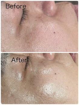 ルミネル 名古屋新栄(Luminelle)/美白