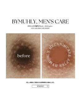 モア(more.)/黒ずみケア一回の変化