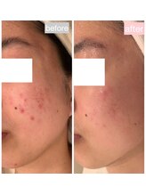 ジェニックサロン グランドギンザ ひたちなか(GENIC SALON GRAND GINZA)/本気の肌改善