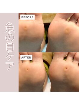 ドクターネイル爪革命 群馬両毛店/タコ・魚の目ケア
