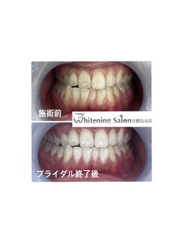 ホワイトニングサロン 京都烏丸店/ホワイトニング施術例