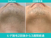 ミスターアンクール 鹿児島(Mr.uncoeur)/ヒゲ脱毛2回後から3週間経過