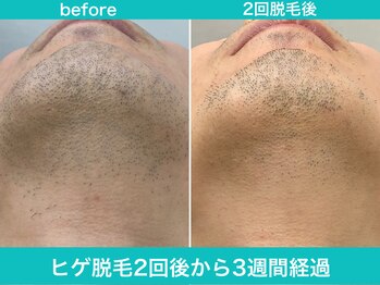 ミスターアンクール 鹿児島(Mr.uncoeur)/ヒゲ脱毛2回後から3週間経過