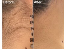 CDF 赤坂/全身脱毛顔＆VIO４回目初回16500