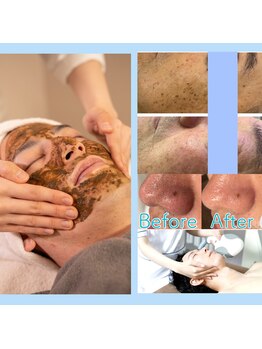 シャイニー(SHINY)/メンズフェイシャル