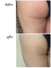 エルール トータルビューティ(Aileure total beauty)/インディバ×燃焼ジェル