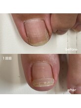 リリ(lili)/巻き爪矯正1回目（左親指）