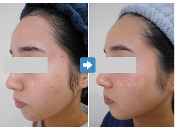 肌質改善サロン 姫路駅前店/肌質改善(ニキビケア肌荒れ緩和)