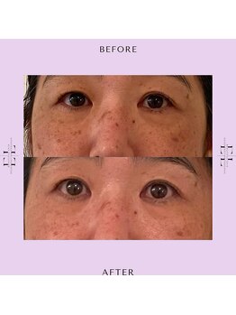 レミュ(Les mieux)/エクソリフト