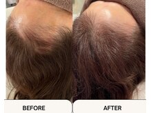 1:【通院】で結果が出なかった方へ【育毛促進】の最大の秘訣～頭皮洗浄スパと光線療法で自律神経も整える～