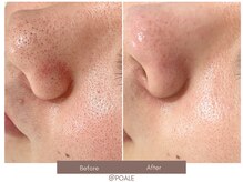 ポアレ 高崎店(POALE)/毛穴ケア症例【群馬/高崎】