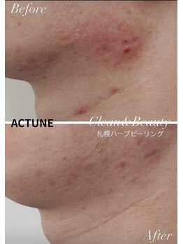 クリーンアンドビューティ 札幌(Clean&Beauty)/刺激の少ないニキビケア専用は!