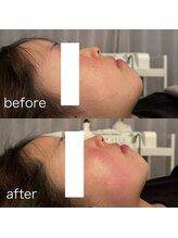 サロン ニコリー(Salon Nicolly)/RED SHOT施術1回のbefore after