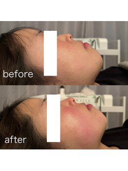 サロン ニコリー(Salon Nicolly)/RED SHOT施術1回のbefore after