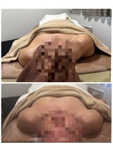 ベルフェム(Bellefemme)/肩の変形からくる手首の痛み