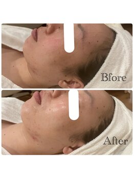 ミエル(miel)/ホワイトニングリンパマッサージ