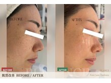 プランス 熊本(PLANCE)/肌質改善 症例