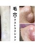 毛穴黒ずみを徹底改善！毛穴洗浄コース　初回体験7,980円