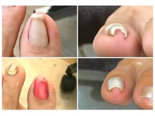 アビエンスネイル(a bean's nail)の雰囲気（無色は勿論！凸凹無くジェルやポリッシュを塗れる巻き爪矯正）