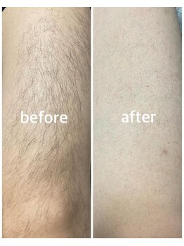 バルミー(Balmy)/太もも脱毛の劇的変化