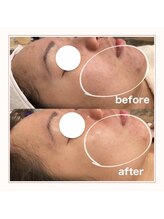 エアリアル 博多店/1回体験 before→after