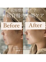 クリニカルホワイトケア 和泉府中店(クリニカルWHITEケア)/ほうれい線撃退！！！(1回)