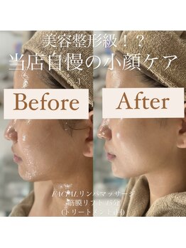 クリニカルホワイトケア 和泉府中店(クリニカルWHITEケア)/ほうれい線撃退！！！(1回)