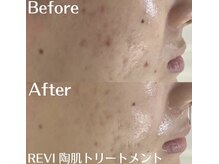 ホワイトアクア 中目黒店(WHITE AQUA)/ハーブピーリング　3回