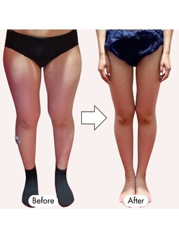 じぶんdeエステ 池袋店/痩せにくい脚もエステマシンで!