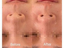 リアン(Lien)/毛穴洗浄ハイドロスプラッシュ