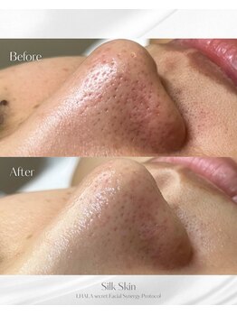 レアビューティー(Le'a beauty)/ララピール第2章SilkSkin Peel