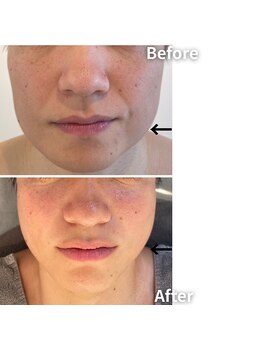 エムボーテ 太田店(M BEAUTE33)/顔筋小顔コルギ