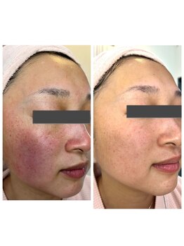 キキラ(kikila)/症例：敏感肌