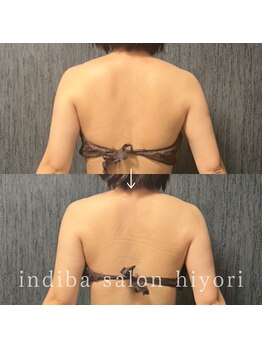 ヒヨリ(hiyori)/《before/after》肩こり改善