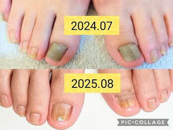 ビソク(VISOK)/変形爪ケアです