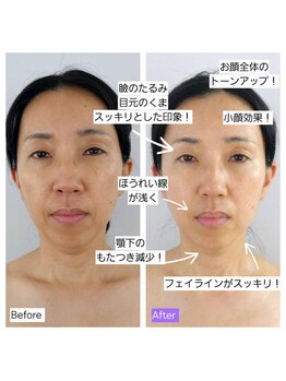 ハリ ヴァカンス(Hari Vacances)/美容鍼×三次元リフト