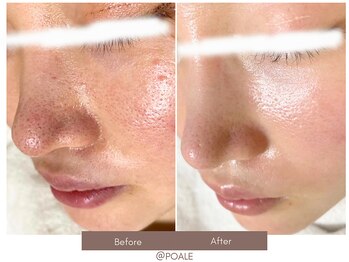 ポアレ 高崎店(POALE)/毛穴ケア症例【群馬/高崎】