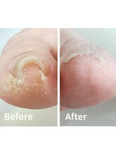 リゼラアンドコー 盛岡店/ドイツ式フットケア専門店　巻爪