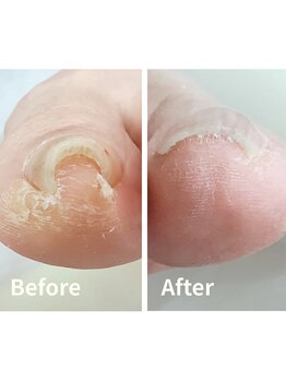 リゼラアンドコー 盛岡店/ドイツ式フットケア専門店　巻爪