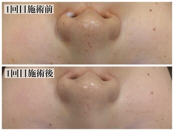 テンニック(10nick)/鼻の黒ずみ1回での変化