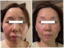 サロン ニコリー(Salon Nicolly)/レモンボトル2cc/before×after