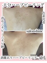 サロンシャイン(Salon Shine)/背中ハード