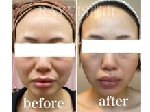 レイビス 郡山店(RAYVIS)/ソフトピーリング×ビタミン導入