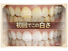 ココホワイトニング(coco whitening)