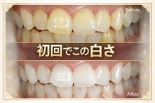 ココホワイトニング(coco whitening)